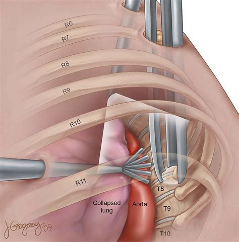 video assisted thoracoscopic surgery.